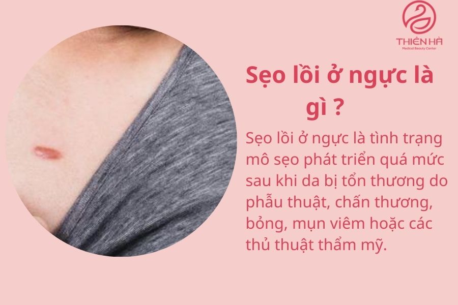 Sẹo lồi ở ngực là gì ?