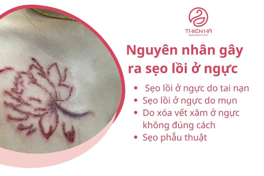 Xóa vết xăm ở ngực không đúng cách gây ra sẹo lồi