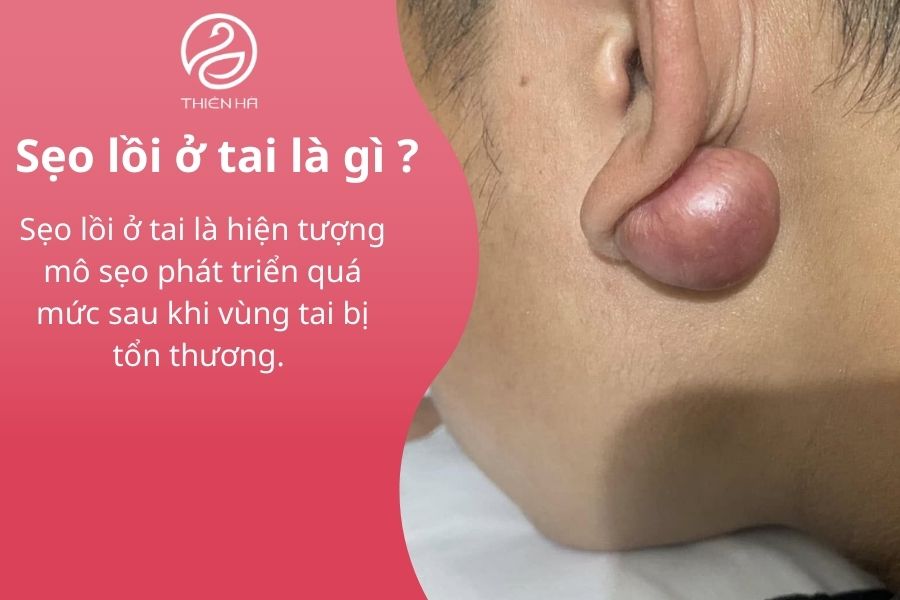 Khái niệm sẹo lồi ở tai 