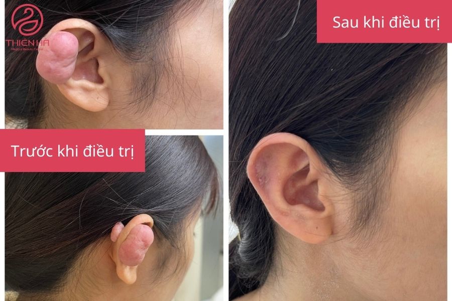 Kết quả trước và sau điều trị sẹo lồi ở tai 