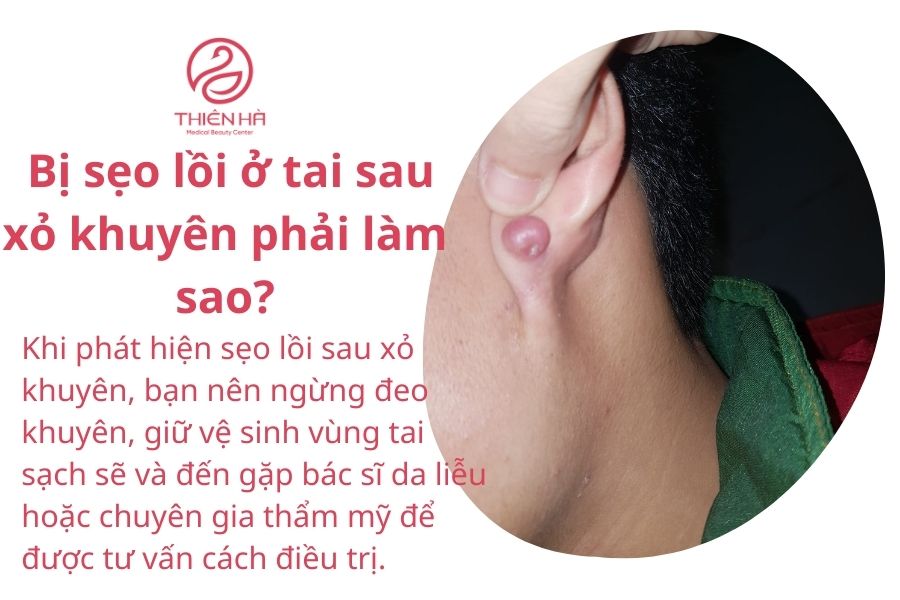 Câu hỏi thường gặp về sẹo lồi ở tai 