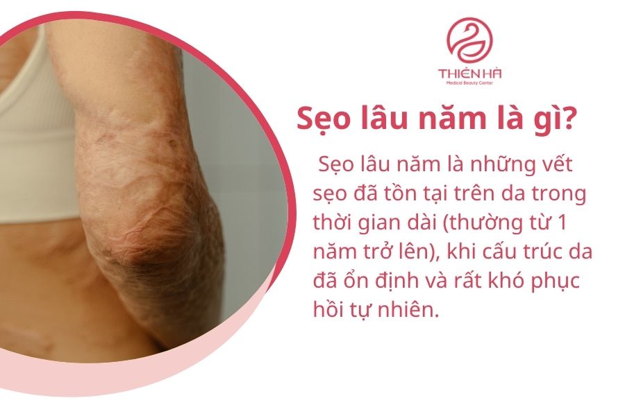 Sẹo lâu năm là gì?