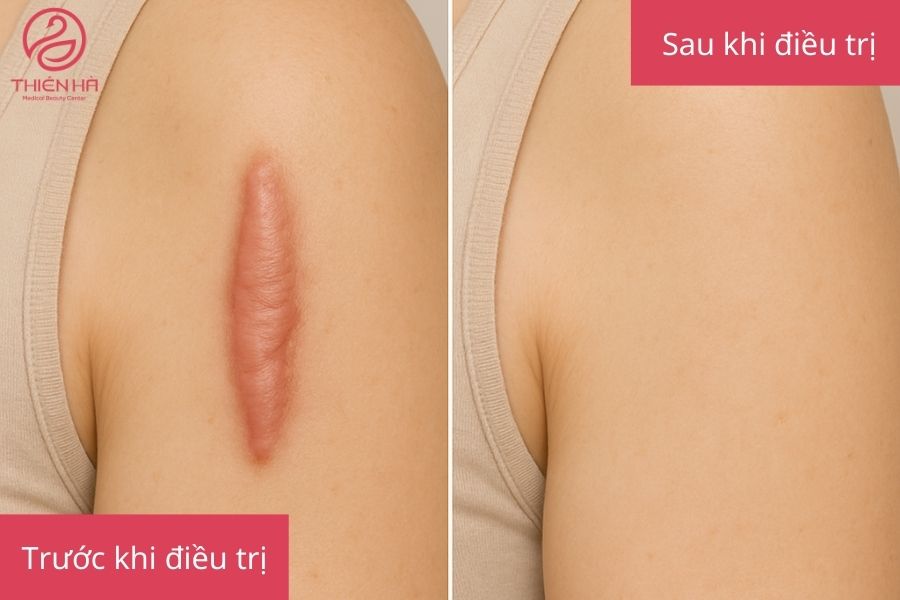 Kết quả sau điều trị sẹo lồi bằng laser