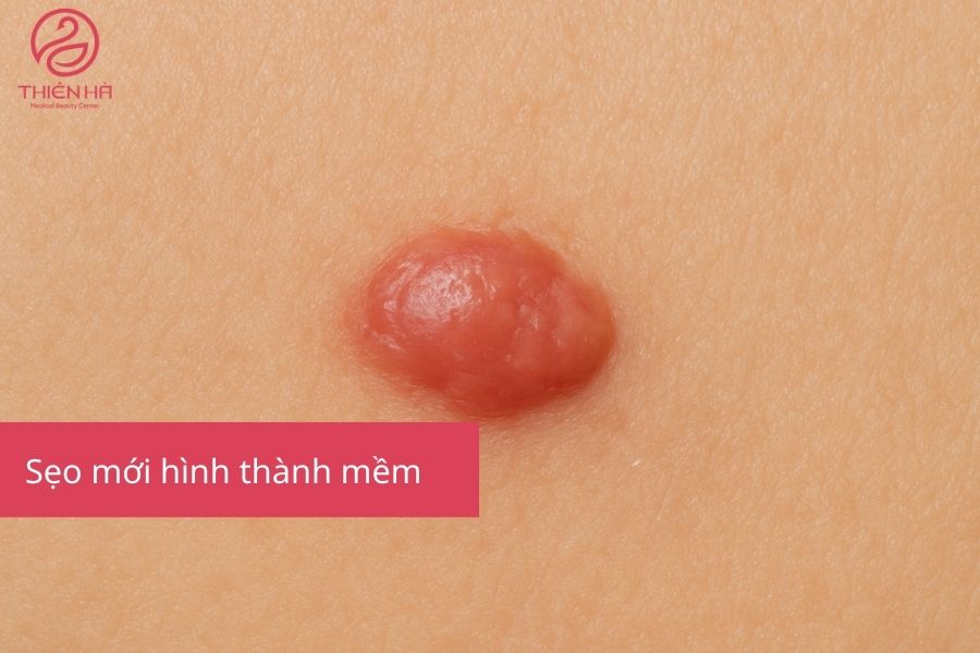 Sẹo mới hình thành mềm