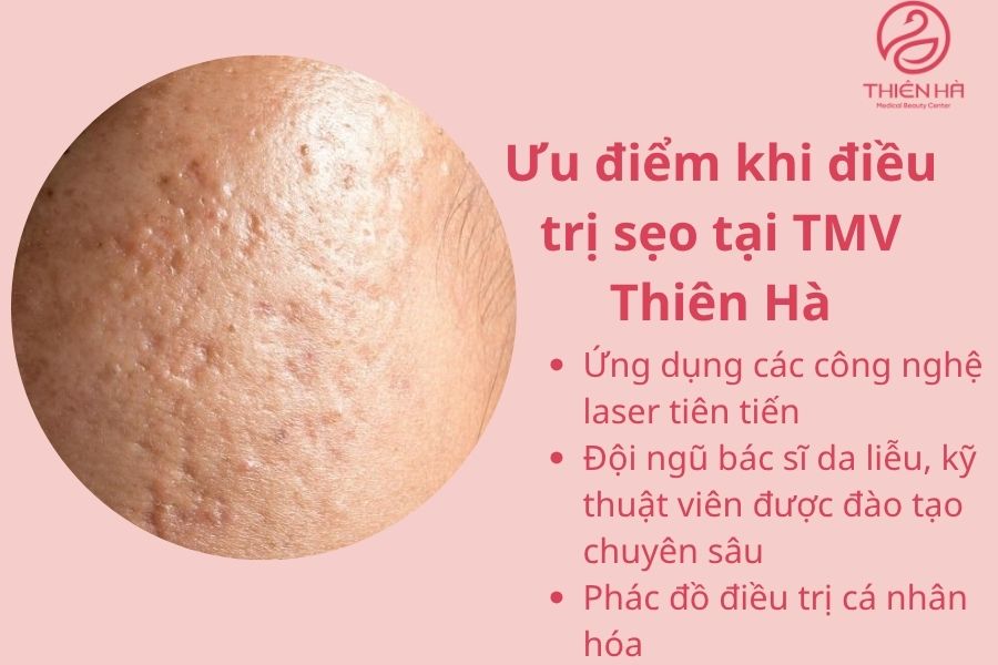 Ưu điểm xóa sẹo bằng laser