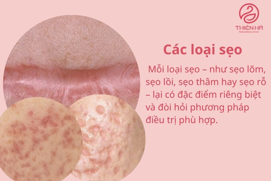 Các loại sẹo