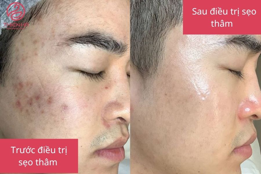 Hình ảnh trước và sau khi điều trị sẹo thâm
