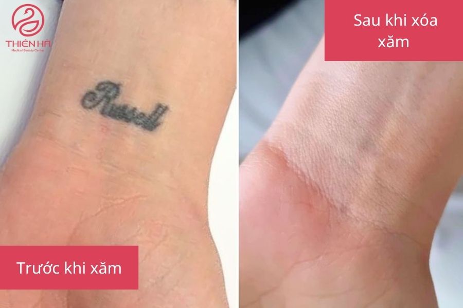 Hình ảnh minh họa trước và sau khi xóa xăm 