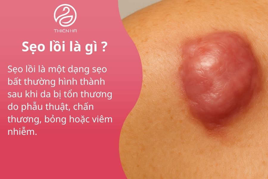Khái niệm về sẹo lồi 
