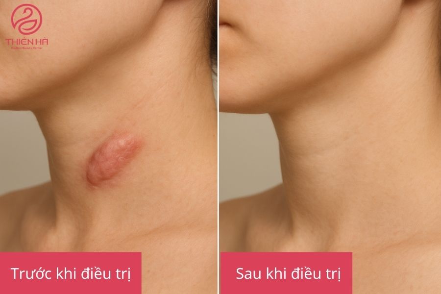Kết quả điều trị sẹo lồi 