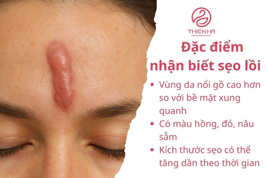 Đặc điểm nhận biết sẹo lồi