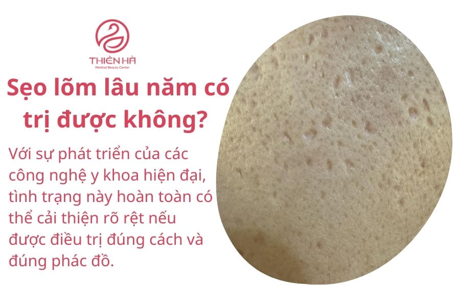 Sẹo lõm lâu năm có trị được không?