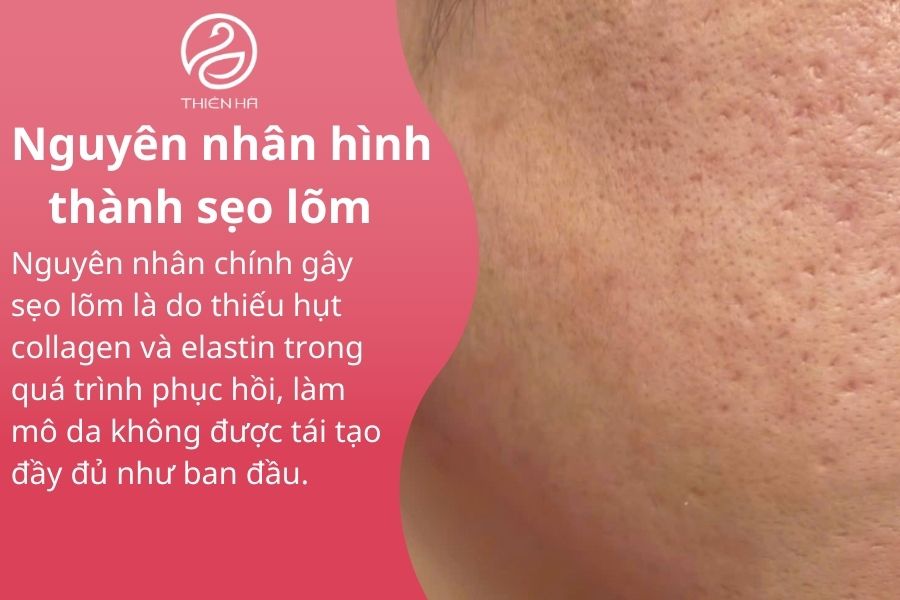 Nguyên nhân hình thành sẹo lõm 