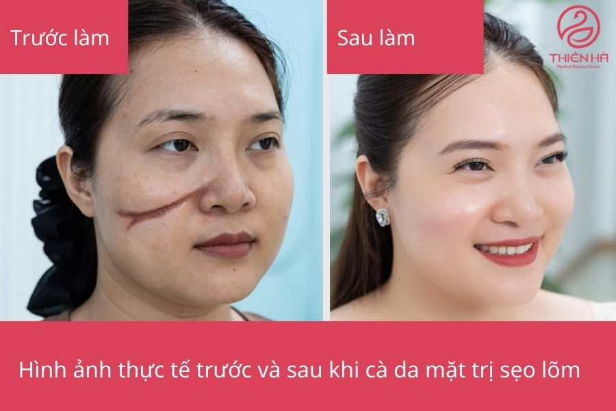 Kết quá thực tế trước và sau khi cà da mặt trị sẹo lõm 