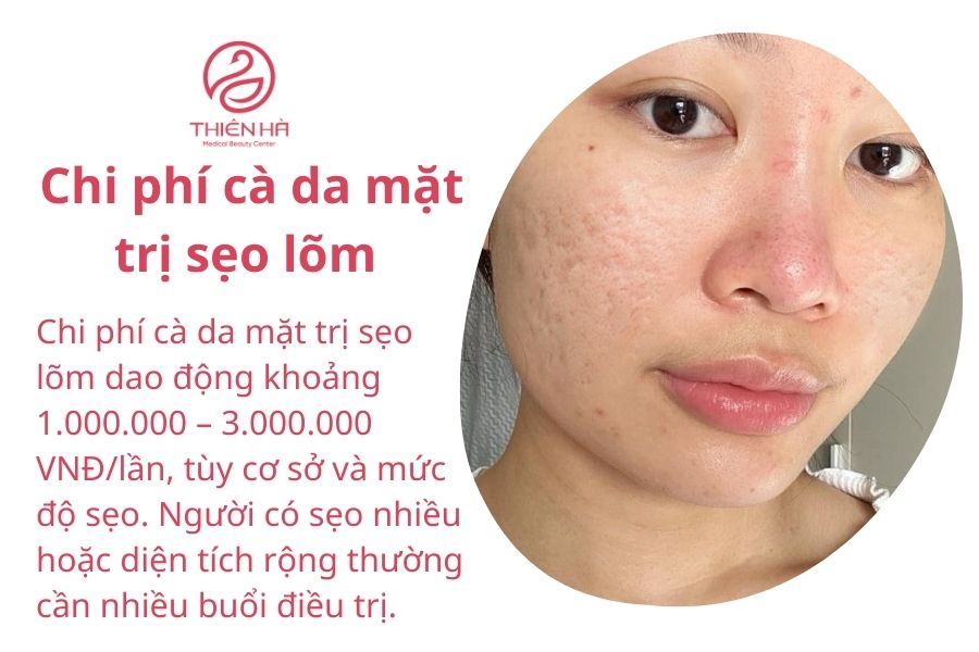 Chi phí cà da mặt trị sẹo lõm
