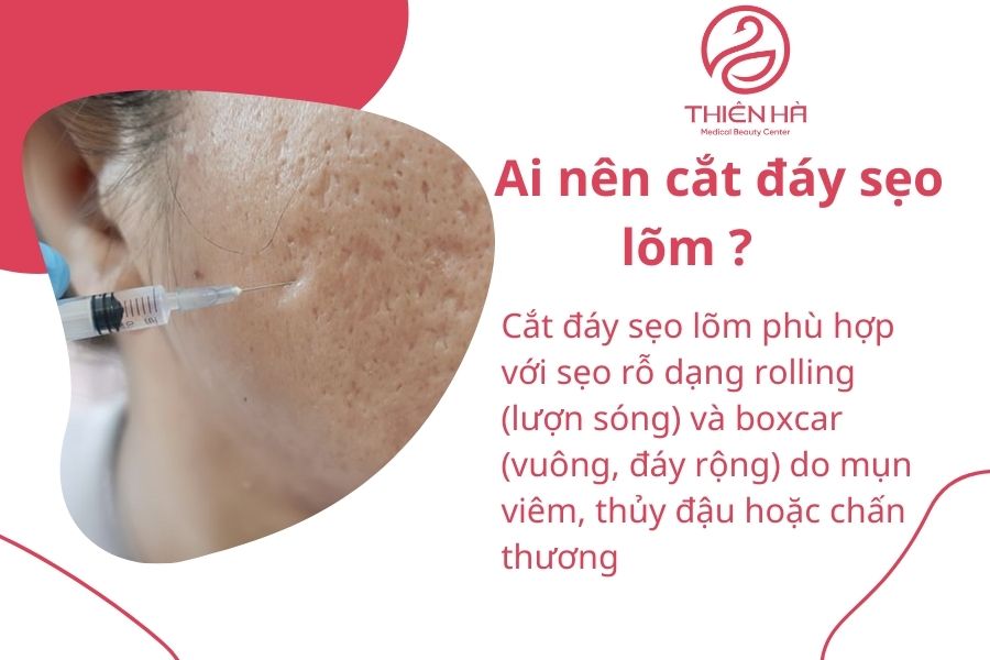 Đối tượng nên cắt đáy sẹo lõm 