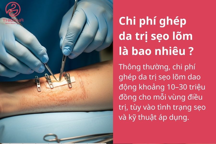 Chi phí ghép da trị sẹo lõm là bao nhiêu ? 