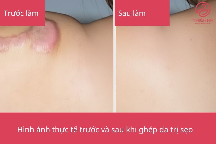 Kết quả sau thực hiện ghép da trị sẹo 
