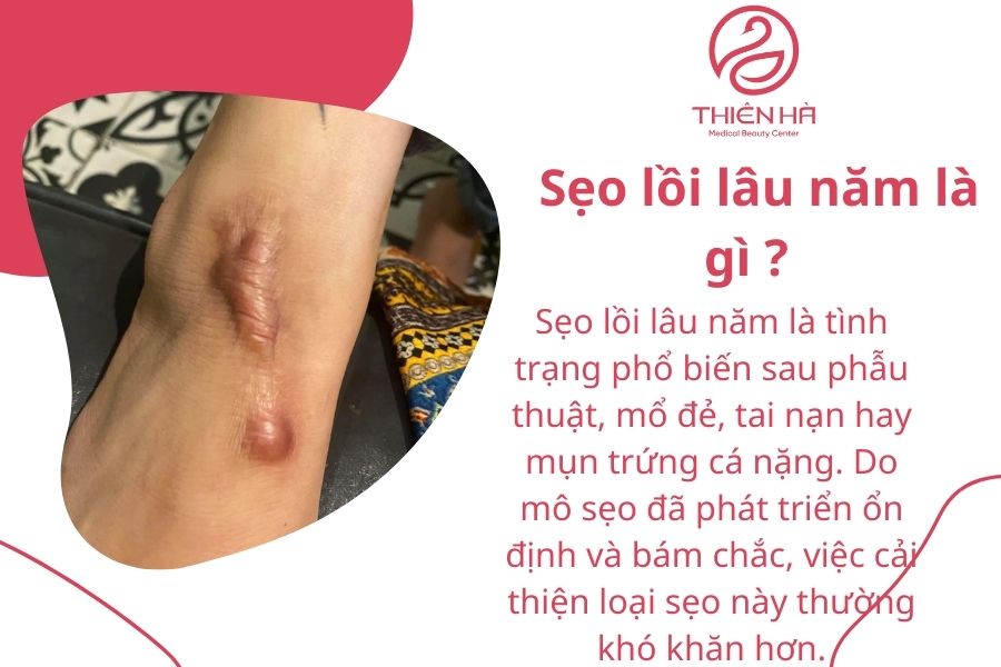 Sẹo lồi lâu năm là gì ? 