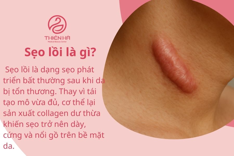 Sẹo lồi là gì?