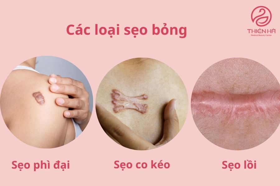 Các loại sẹo bỏng