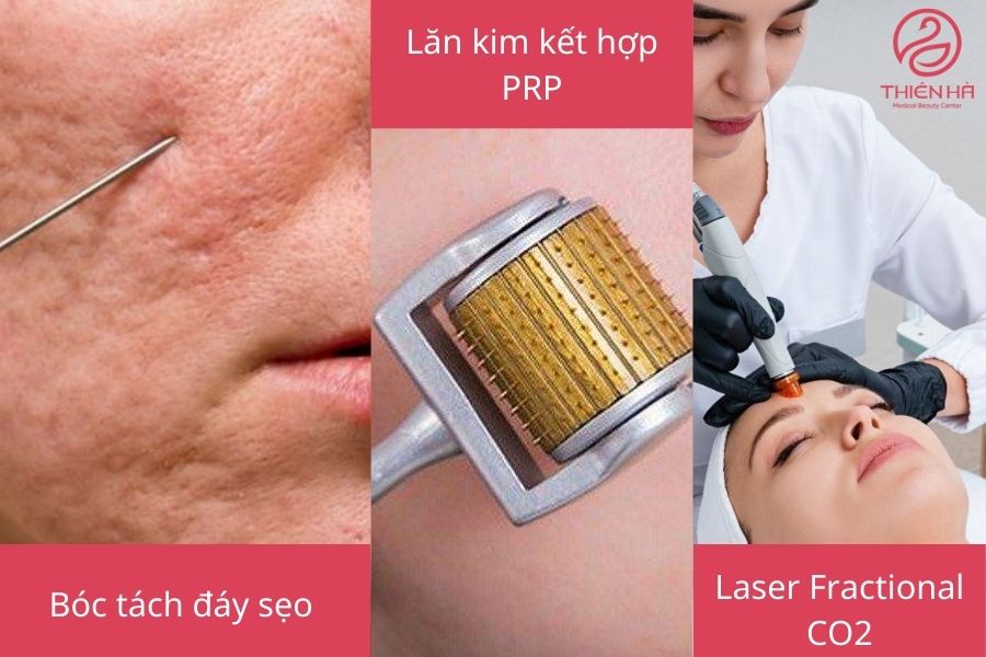  Các phương pháp điều trị sẹo lõm hiện đại