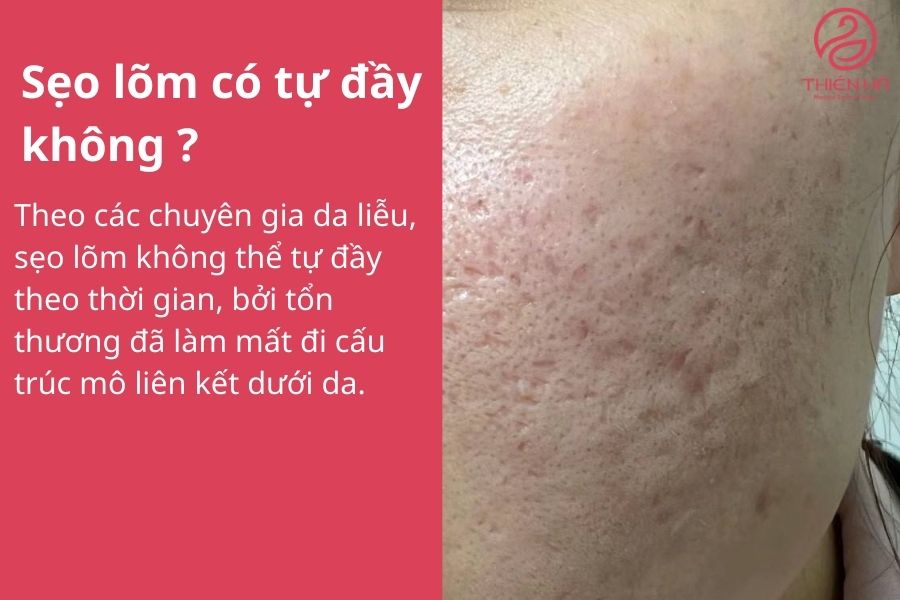 Sẹo lõm có tự đầy không ? Lời khuyên từ chuyên gia 