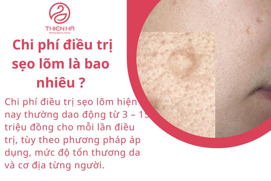 Chi phí điều trị sẹo lõm là bao nhiêu