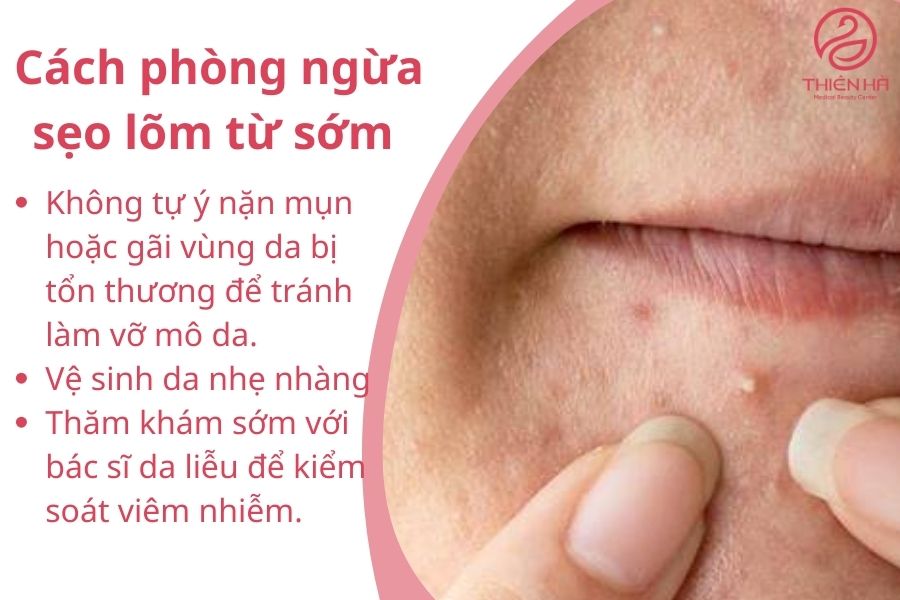 Cách phòng ngừa sẹo lõm từ sớm