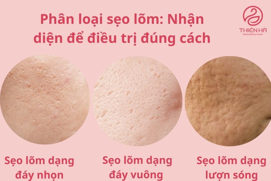 Các loại sẹo lõm 