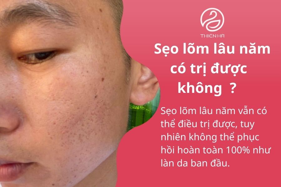 Sẹo lõm lâu năm có trị được không ? 