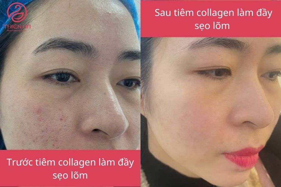 Kết quả sau khi khách hàng tiêm collagen làm đầy sẹo lõm