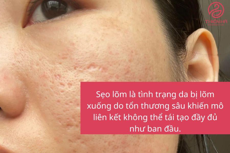 Sẹo lõm là gì ? 