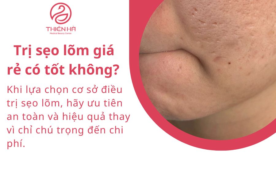 Trị sẹo lõm giá rẻ có tốt không?