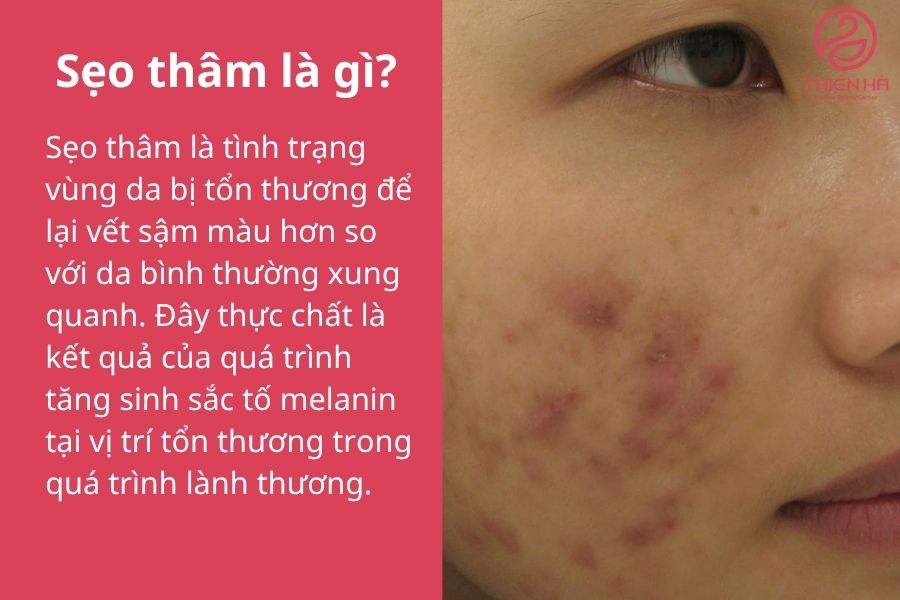 Sẹo thâm là gì?