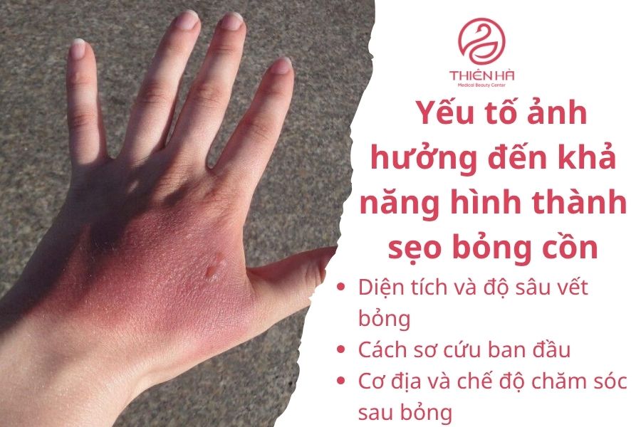 Yếu tố ảnh hưởng đến khả năng hình thành sẹo bỏng cồn