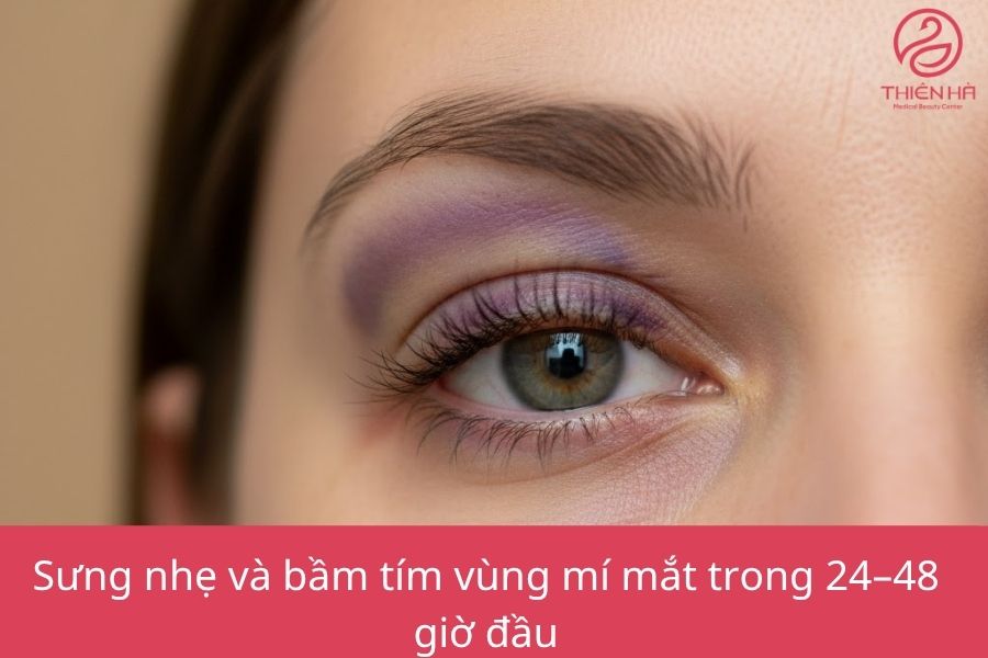 Sưng nhẹ và bầm tím vùng mí mắt 