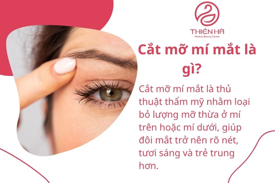Cắt mỡ mí mắt là gì?