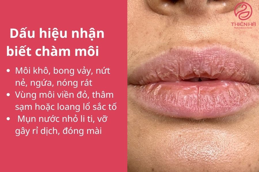 Môi khô, bong vảy, nứt nẻ