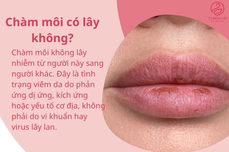 Chàm môi có lây không?