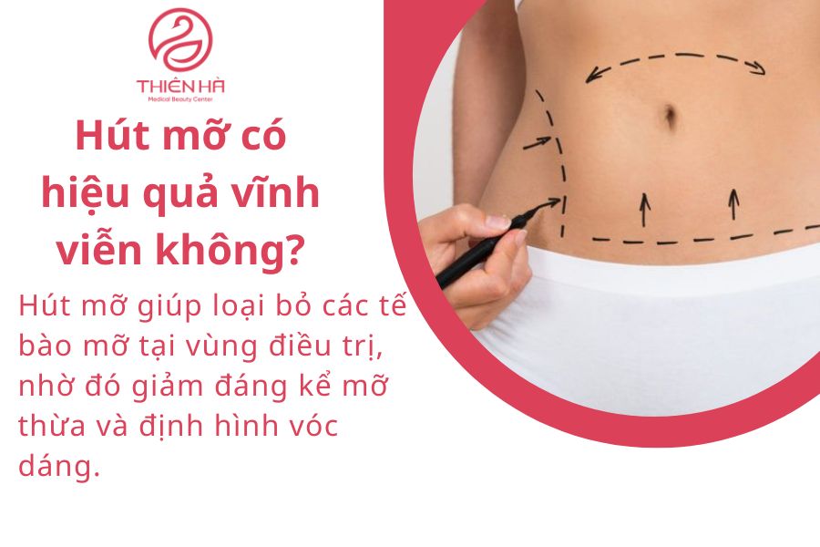Hút mỡ có hiệu quả vĩnh viễn không?