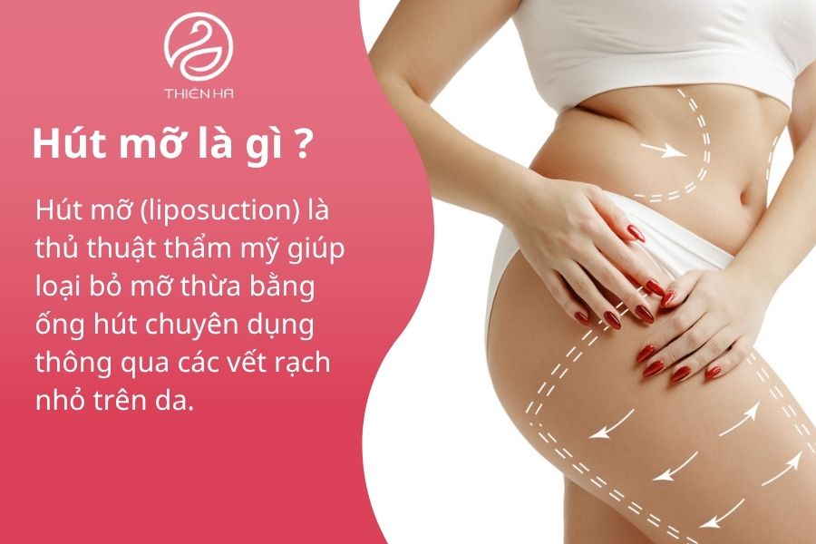 Hút mỡ là gì ?