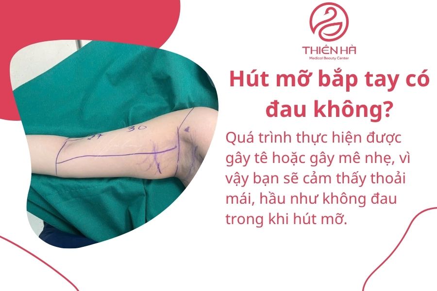 Một số câu hỏi thường gặp về hút mỡ bắp tay 