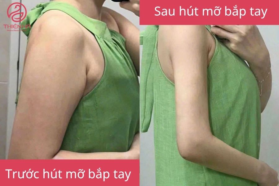 Kết quả sau hút mỡ bắp tay 