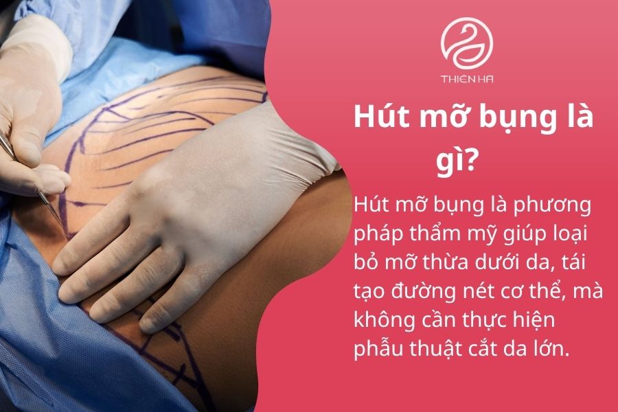Hút mỡ bụng là gì?