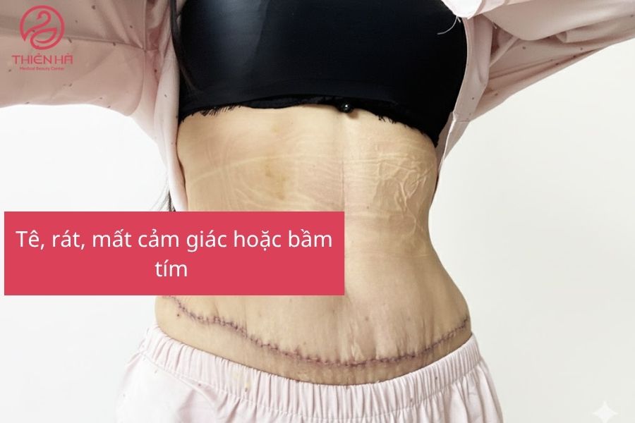 Dấu hiệu biến chứng sau hút mỡ bụng cần lưu ý