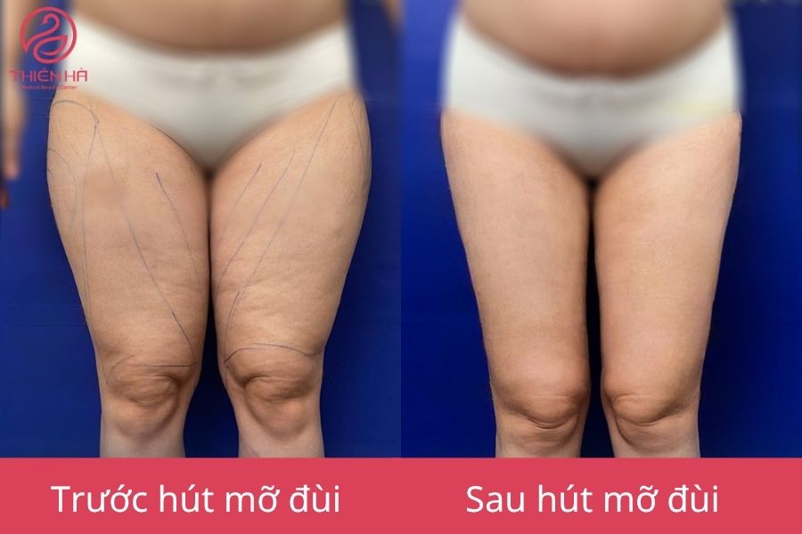 Kết quả sau hút mỡ đùi : Cặp đùi thon gọn