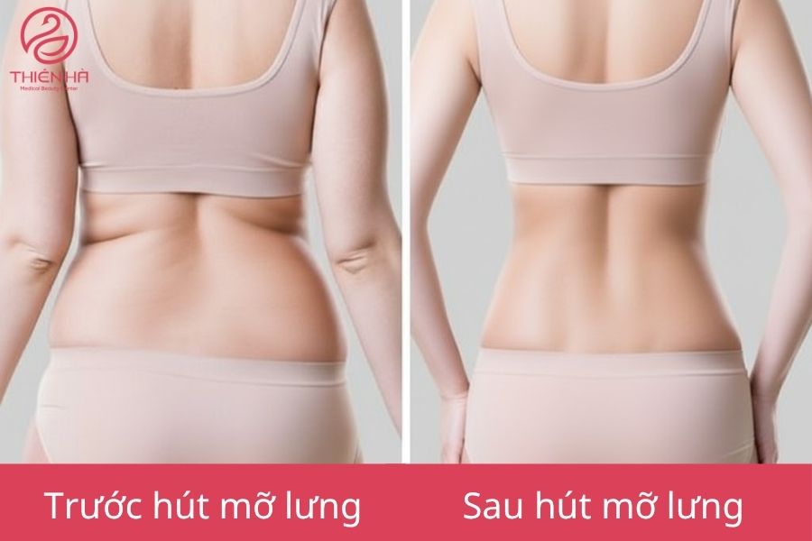 Kết quả sau hút mỡ lưng giúp cải thiện vóc dáng 