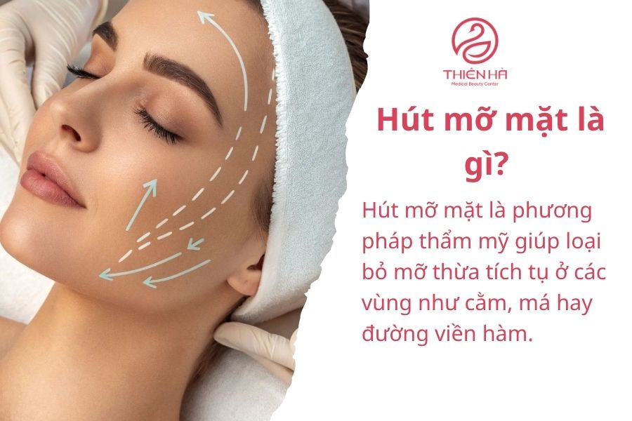 Hút mỡ mặt là gì?