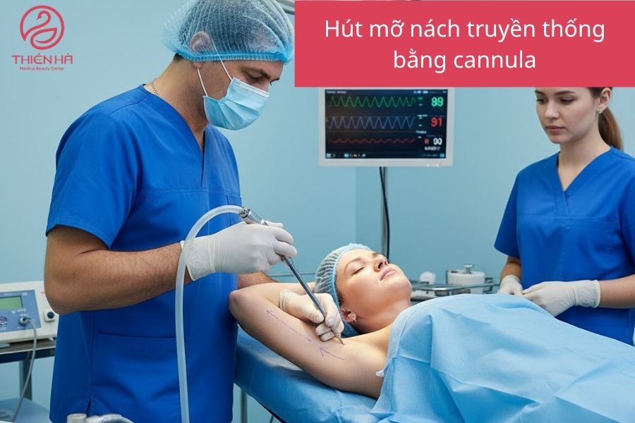 Hút mỡ truyền thống bằng cannula